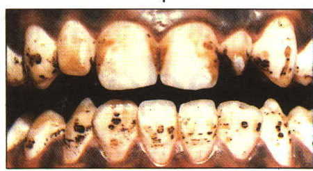 Dirtyteeth.jpg