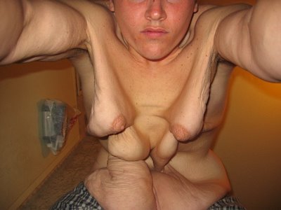 fat-surgery-04.jpg
