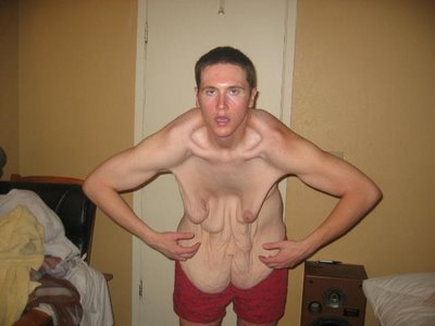 fat-surgery-05.jpg