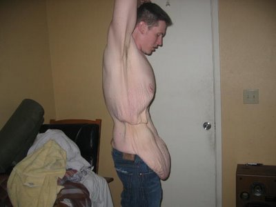 fat-surgery-06.jpg