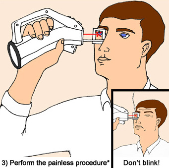 lasik at home kit