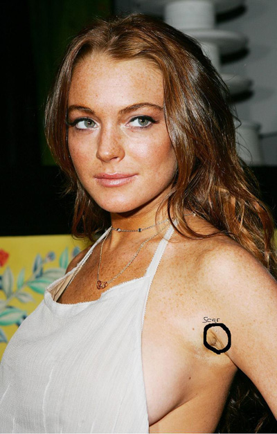 Lindsay Lohan breast implant scar